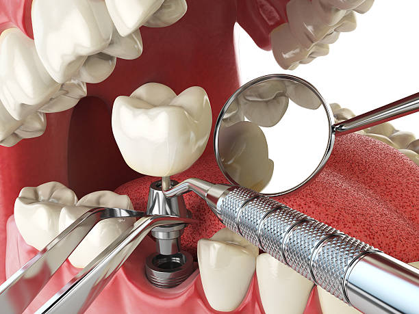 Best Knocked-Out Tooth (Avulsed Tooth) Treatment in Mililani Mauka, HI